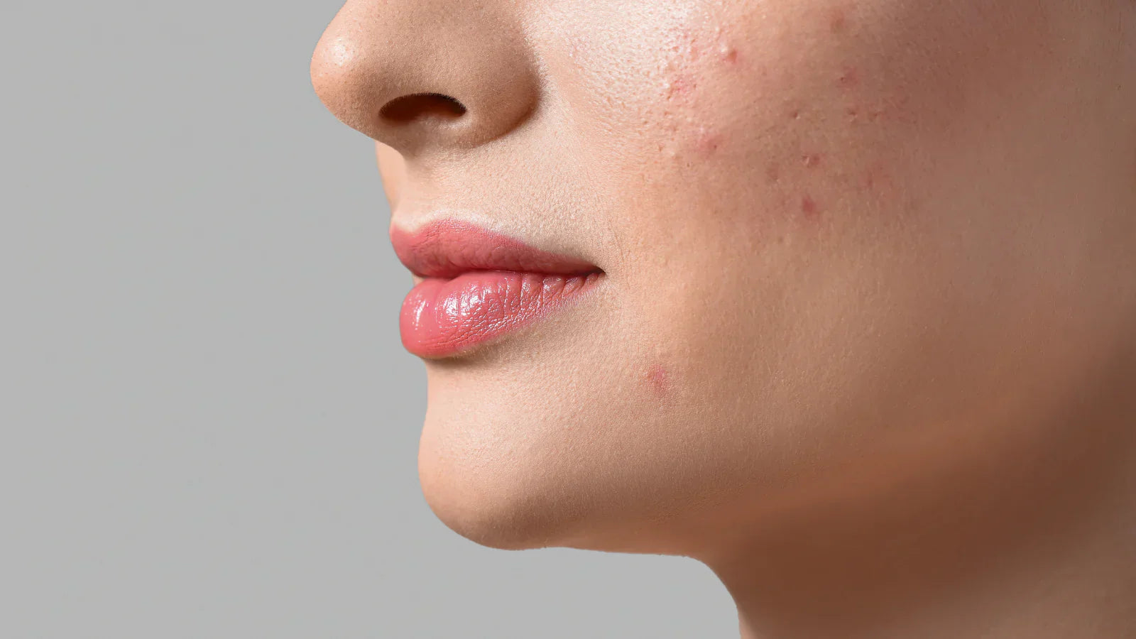 Kör Sivilce Nedir? Kör Sivilce Nasıl Geçer?